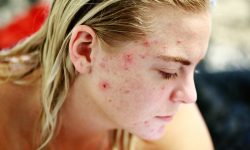 ragazza affetta da acne
